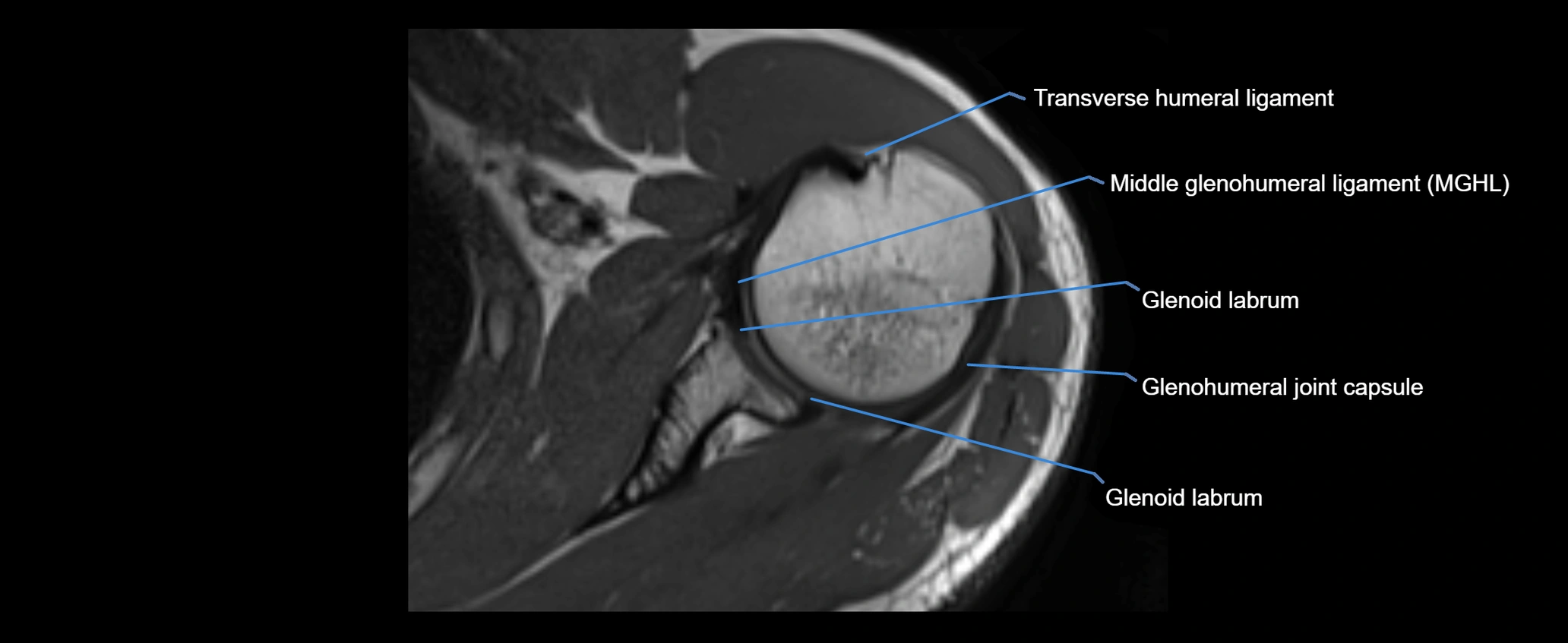 shoulder ligaments axial 3d 3t mri image-img-00005-00061.webp